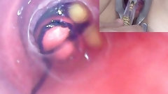 urethra video: Mature Woman, Peehole Endoscope Camera in Bladder with Balls