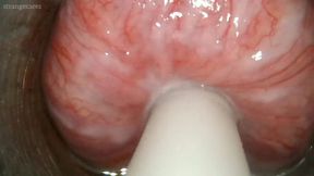 catheter video: bladder exam and cum lube injection