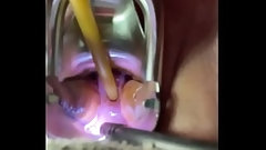 catheter video: Catheterizing uterus painfully