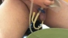 catheter video: Flushing my bladder with water from urinary bag.