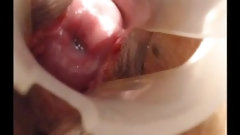 speculum video: Long cervix show, speculum and try to insert pencil
