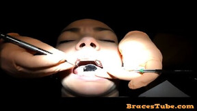 dentist video: Braces Cleaning, dental fetish
