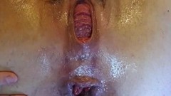 prolapse video: Preview - Extreme Anal and Prolapse