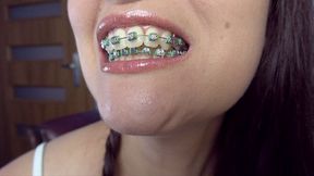 braces video: Weronika - Braces - Green Rubbers - Extreme Close-ups - UHD 3840x2160 - 4K