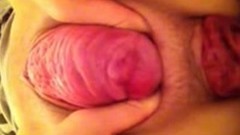 prolapse video: Amateur anal fisting and prolapse